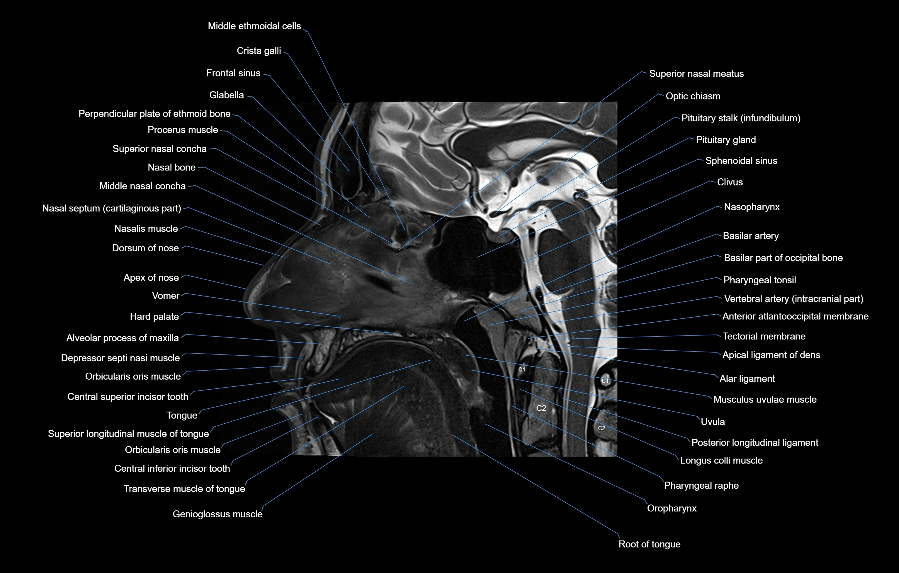 paranasal sinuses(PNS) MRI coronal  cross sectional anatomy 3T radiology  image-img-00001-00003.webp
